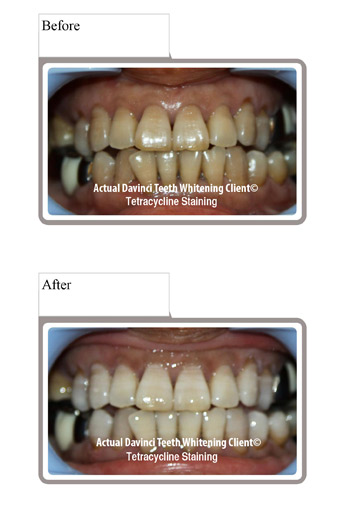 led teeth whitening before after