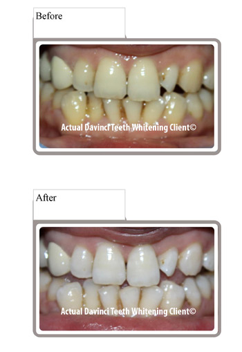 davinci professional laser teeth-whitening session