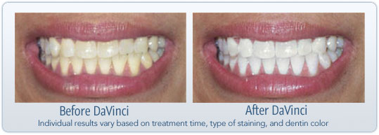 Before and After Results